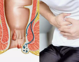 Fistula Surgeon Doctors